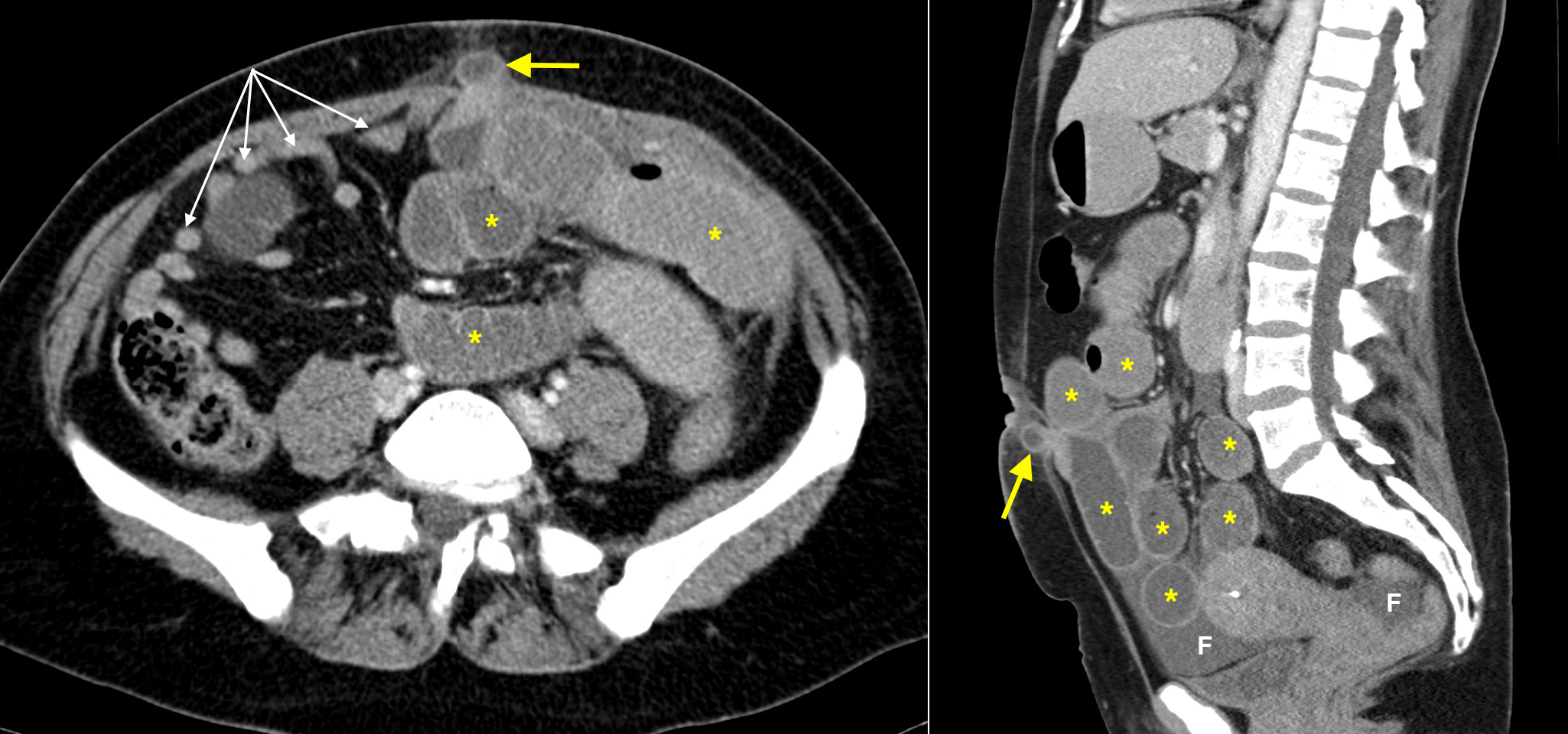 incarcerated-spigelian-hernia-with-mechanical-small-bowel-obstruction