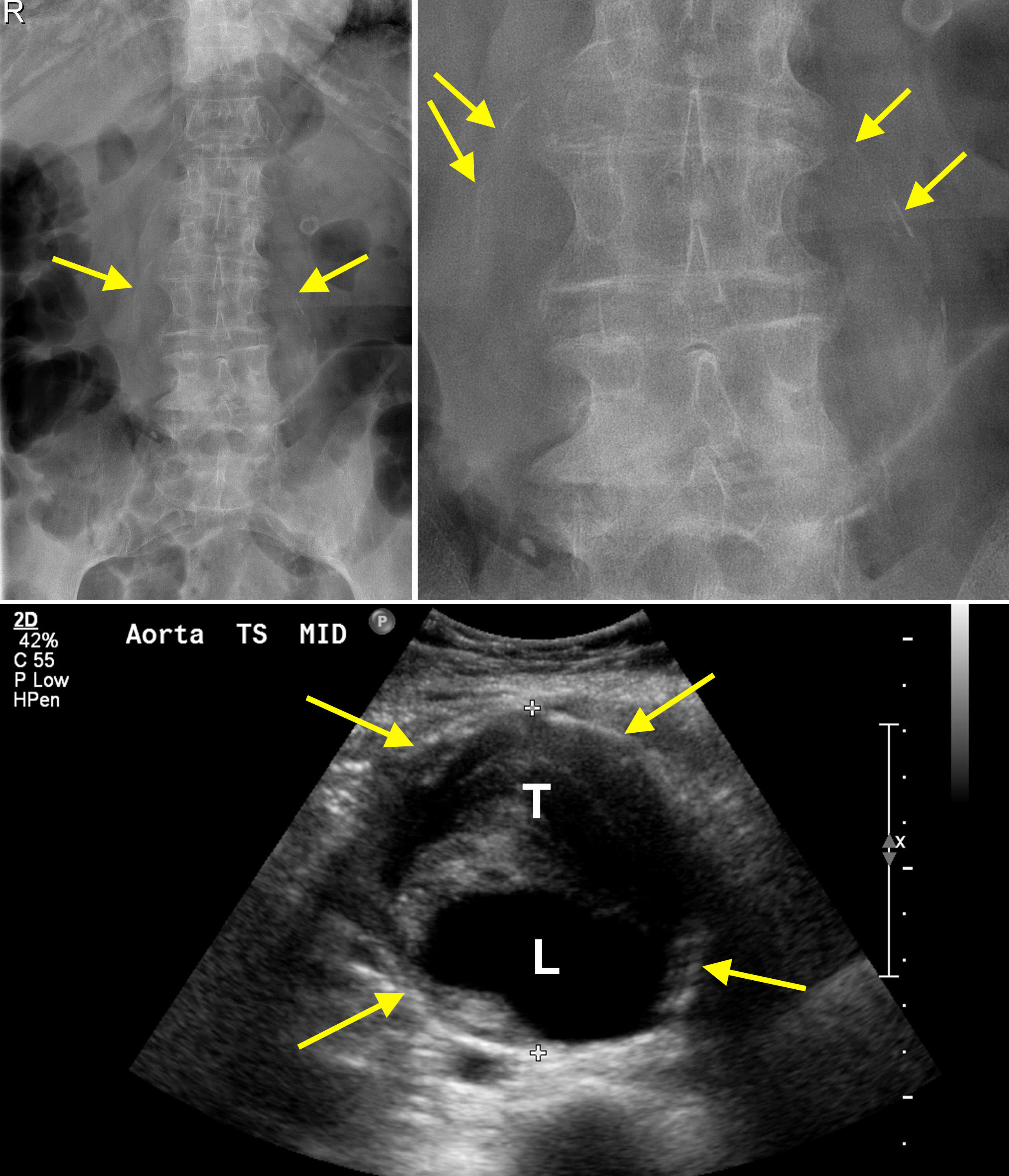 Calcified abdominal aortic aneurysm - lumbar spine radiograph