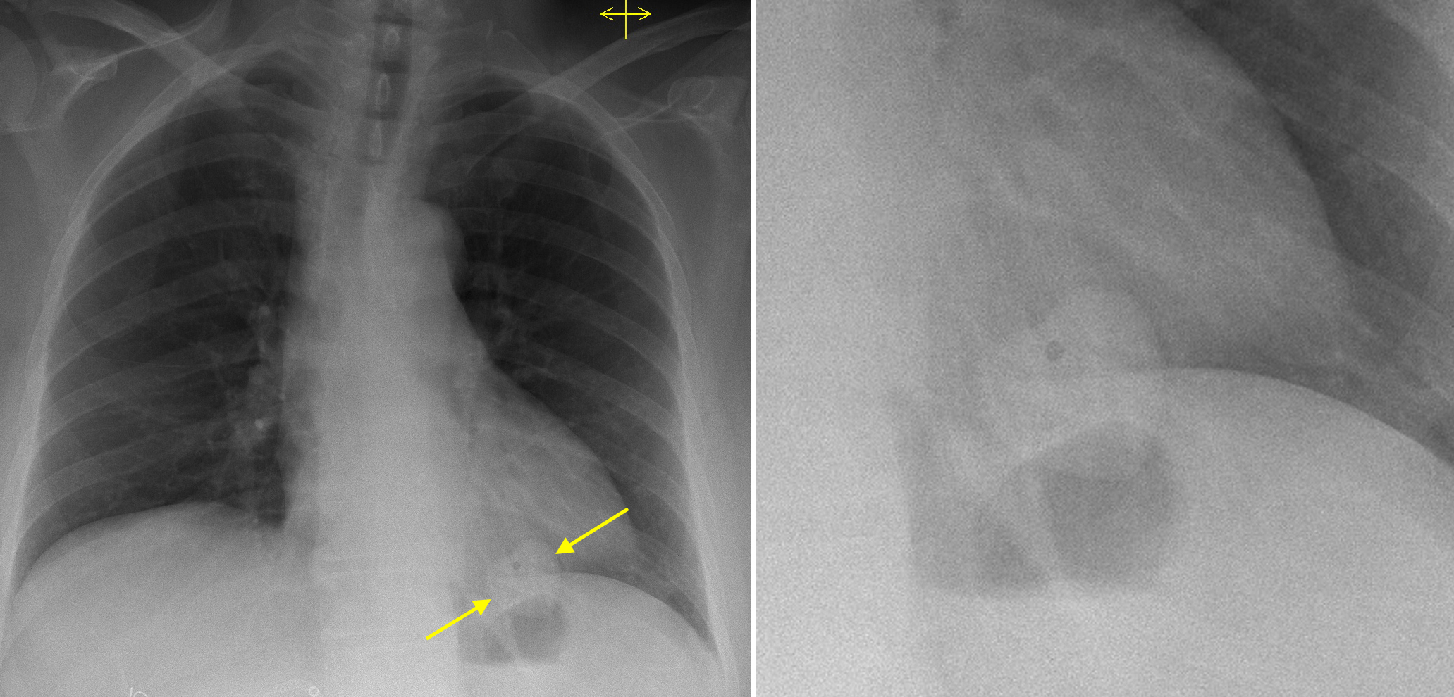 Double Heart Sign Cxr Radiology At St Vincents University Hospital