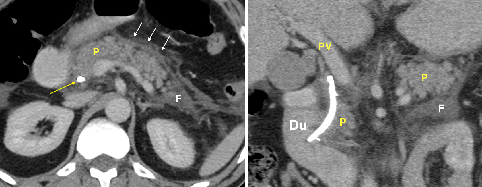 Acute Pancreatitis Post Ercp Radiology At St Vincents University