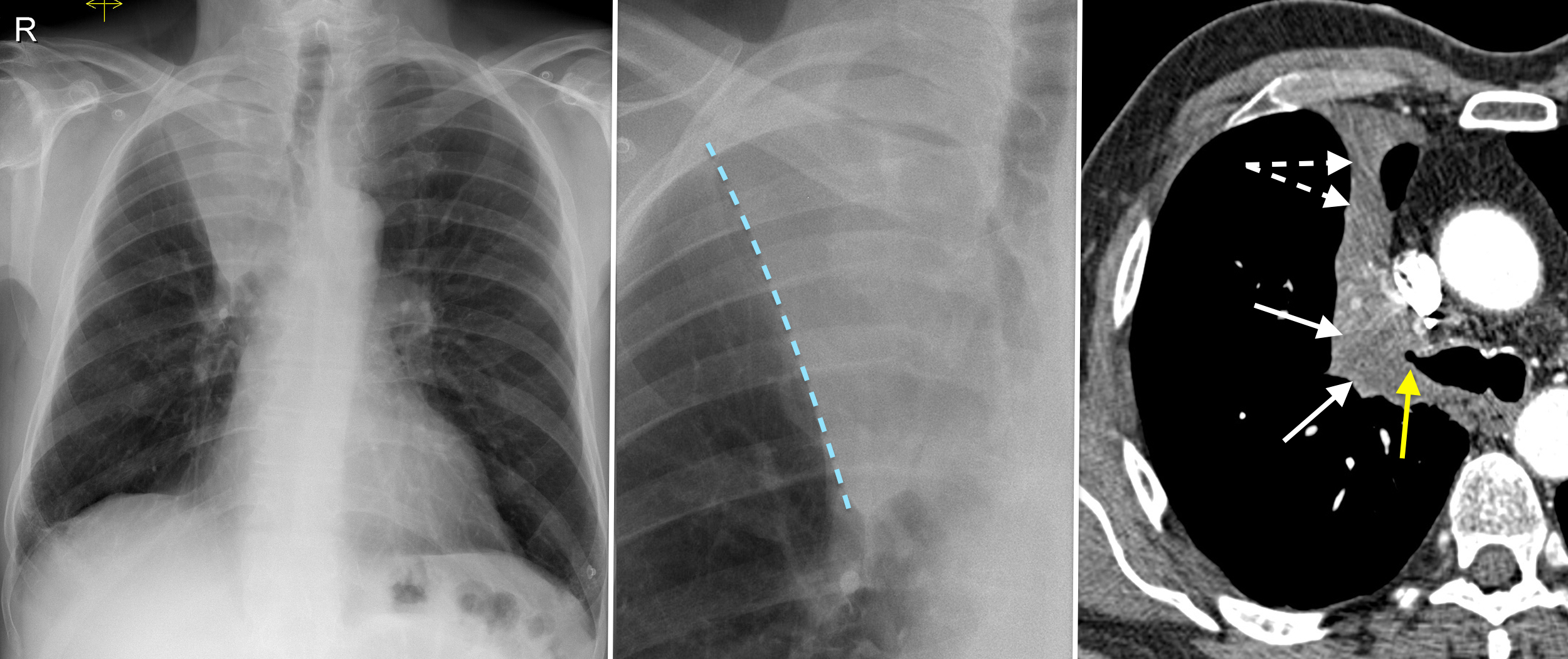 right-upper-lobe-collapse-cxr-ct-radiology-at-st-vincent-s