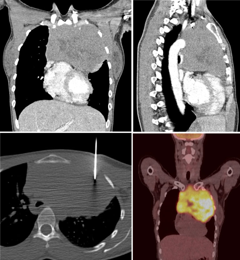 anterior-mediastinal-mass-radiology-at-st-vincent-s-university-hospital