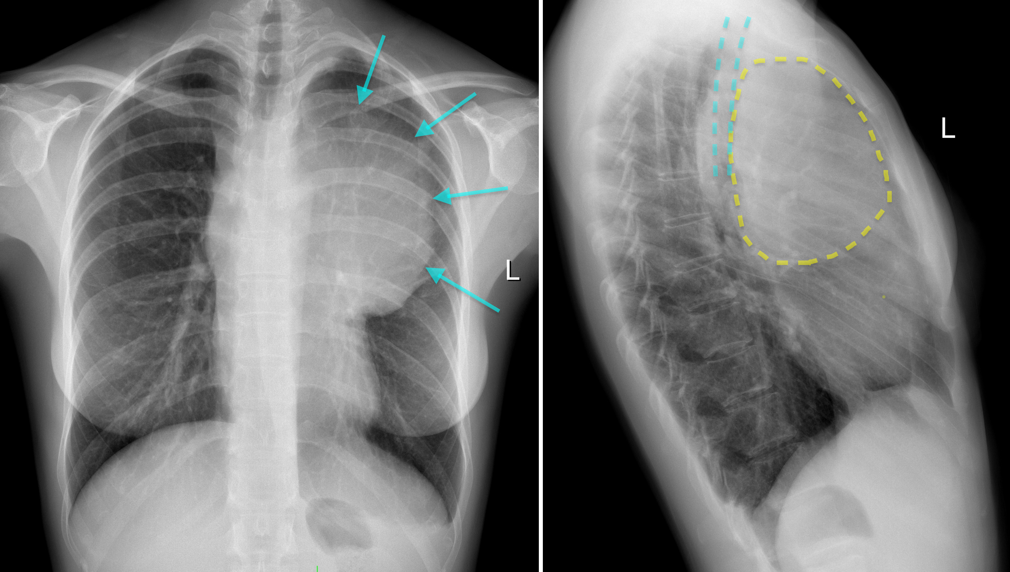 Anterior Mediastinal Mass Radiology At St Vincent s University Hospital