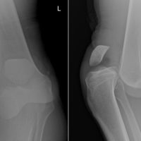 Posterior Knee Dislocation Radiology At St Vincent S University Hospital