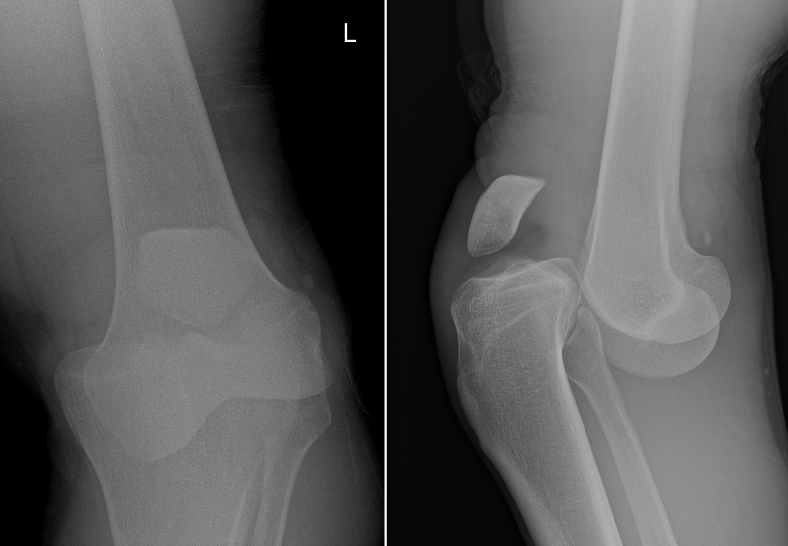 Anterior knee dislocation - Radiology at St. Vincent's University Hospital