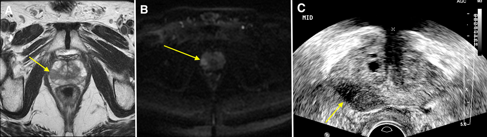 Prostate Cancer Mri Radiology At St Vincents University Hospital