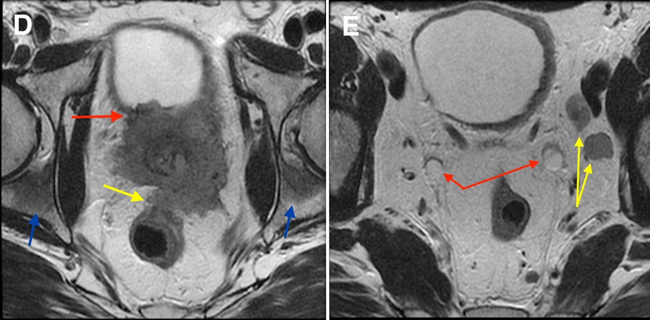 Prostate Cancer Mri Radiology At St Vincents University Hospital