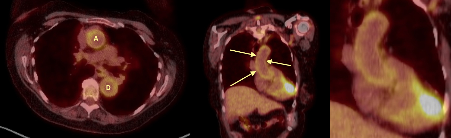 giant-cell-arteritis-radiology-at-st-vincent-s-university-hospital