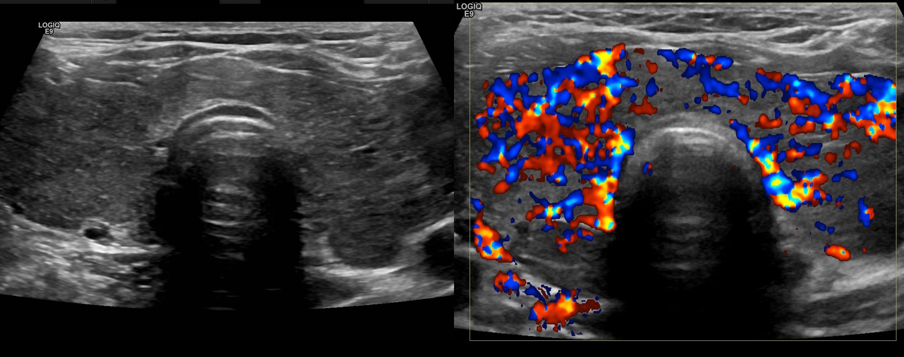 Graves Disease Radiology At St Vincent s University Hospital